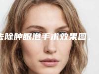 去除肿眼泡手术效果图，去除肿泡眼大概多少钱