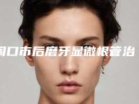 周口市后磨牙显微根管治疗医院排行榜前十位谁做的好（周口市后磨牙显微根管治疗口腔医院不偏不倚中立选）