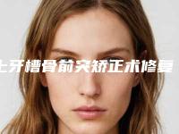 上牙槽骨前突矫正术修复是否安全