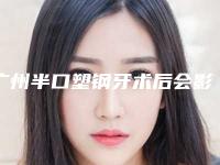 广州半口塑钢牙术后会影响面部表情吗