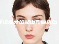 邱凌燕牙齿贴面修复术后护理小技巧