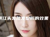 镇江头发植发整形的效果与价格,镇江头发植发术的价格受什么因素影响