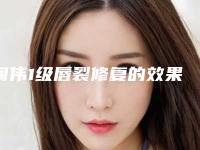 阎伟1级唇裂修复的效果「阎伟1级唇裂效果真实自然吗」
