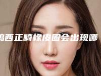鸡西正畸橡皮圈会出现哪些副作用