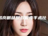 鹤岗眼部割双眼皮手术比较安全